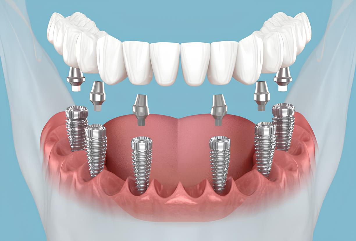https://implantologyschool.com/wp-content/uploads/2025/06/all-on-6.jpg