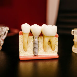 https://implantologyschool.com/wp-content/uploads/2025/06/implant-1-320x320.jpg
